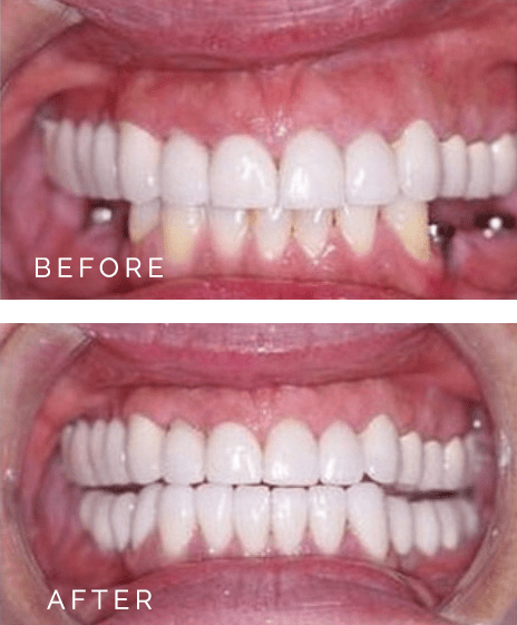Before and After Dental Implants