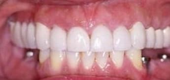 Before Dental Procedure