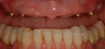 Before Dental Procedure