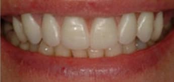 After Dental Procedure