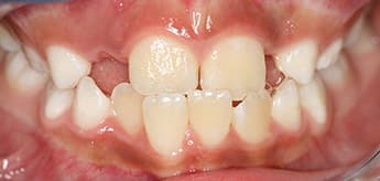Before Dental Procedure