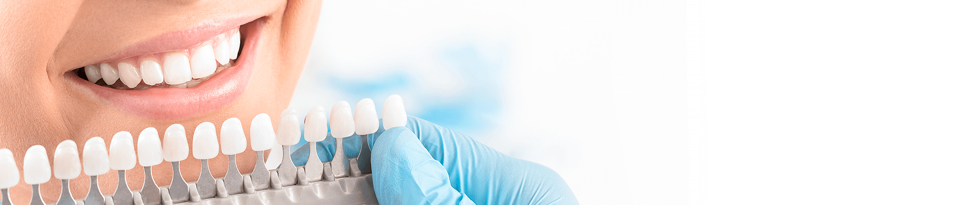 Veneers in Michigan and Indiana