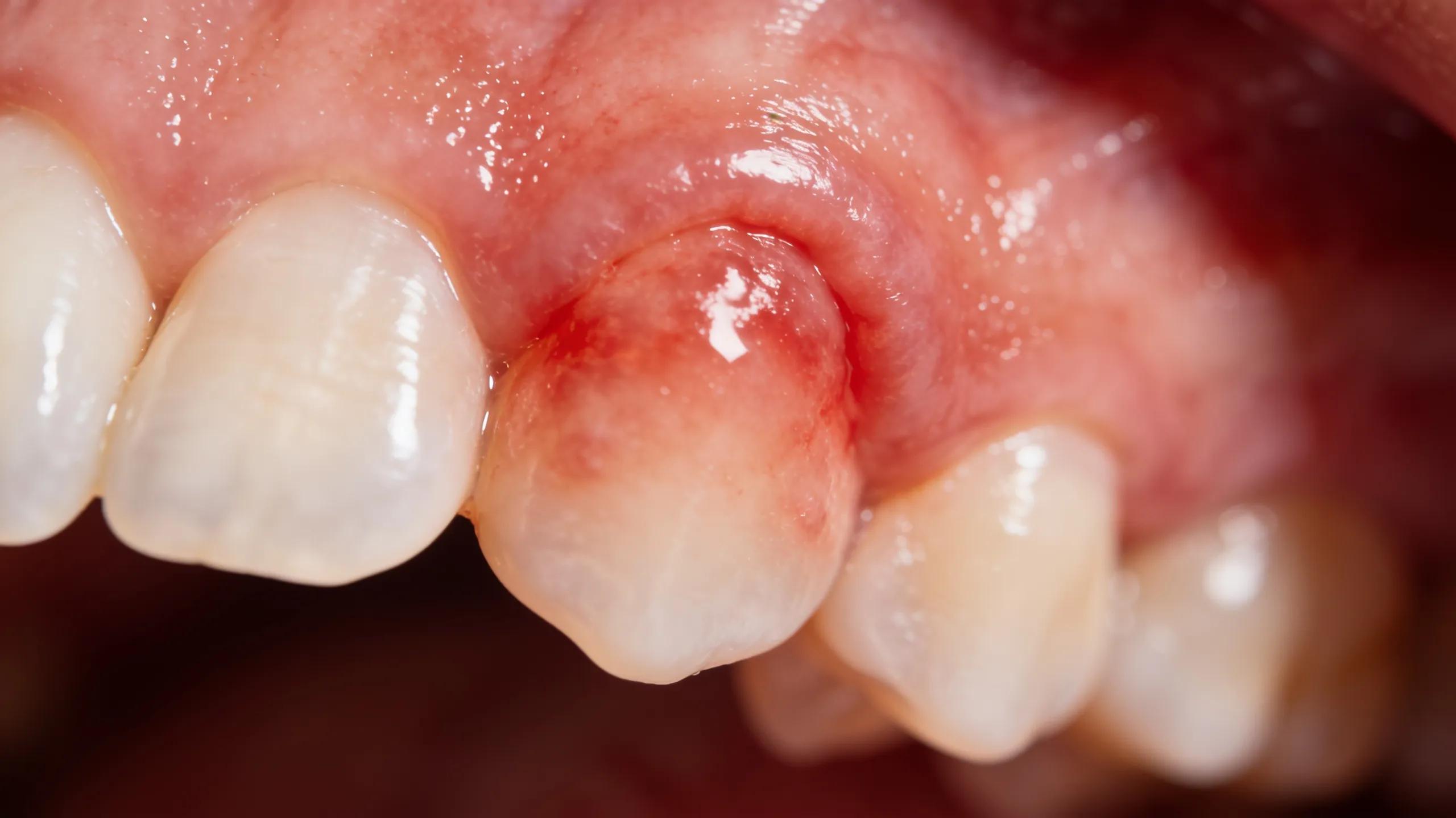 Close-up of swollen gums indicating inflammation, relevant to periodontal issues