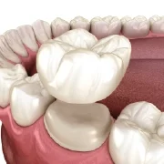 Dental Crowns Dental Crowns