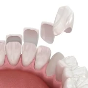 Dental Veneers Dental Veneers