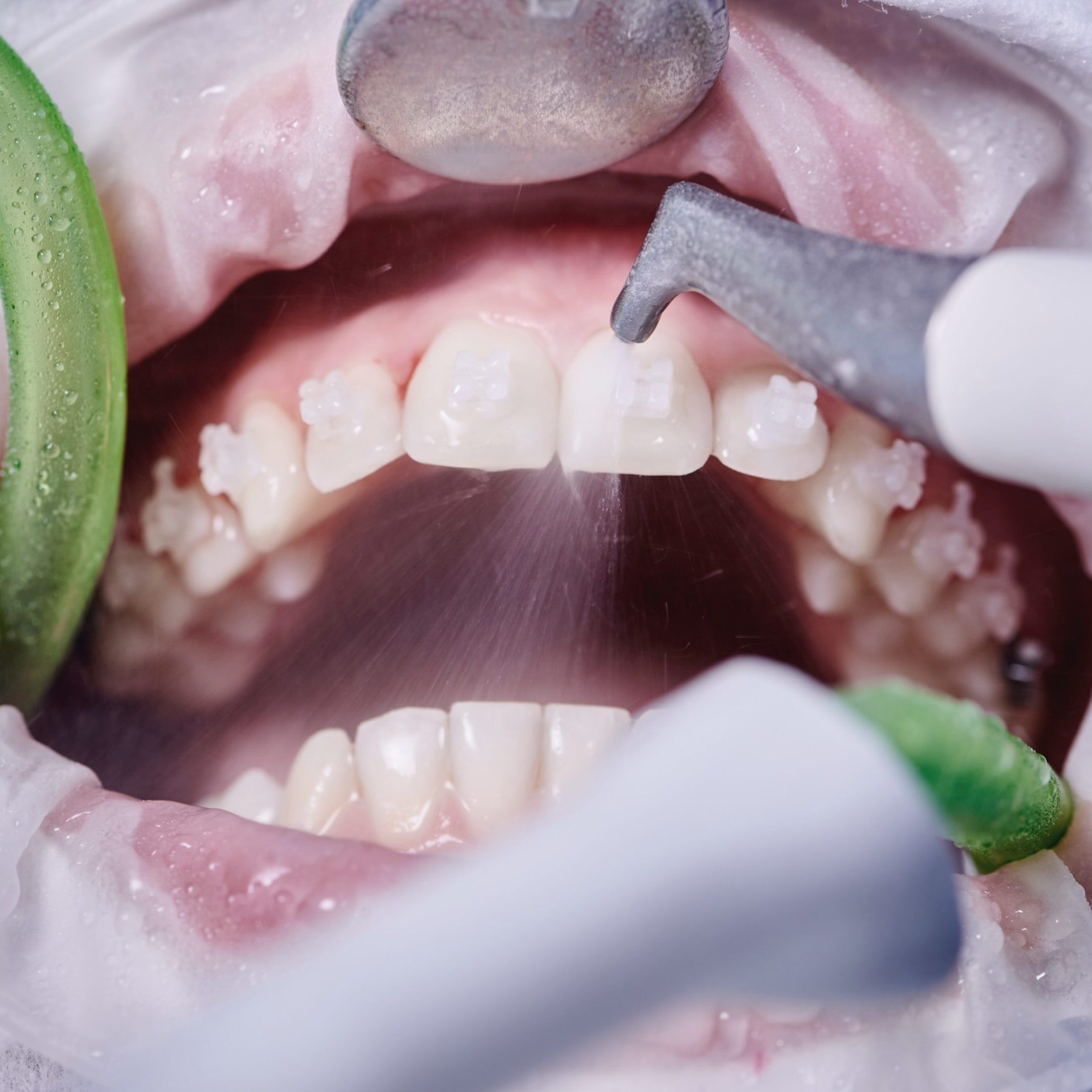 dental-cleaning dental-cleaning