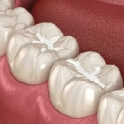 fillings fillings