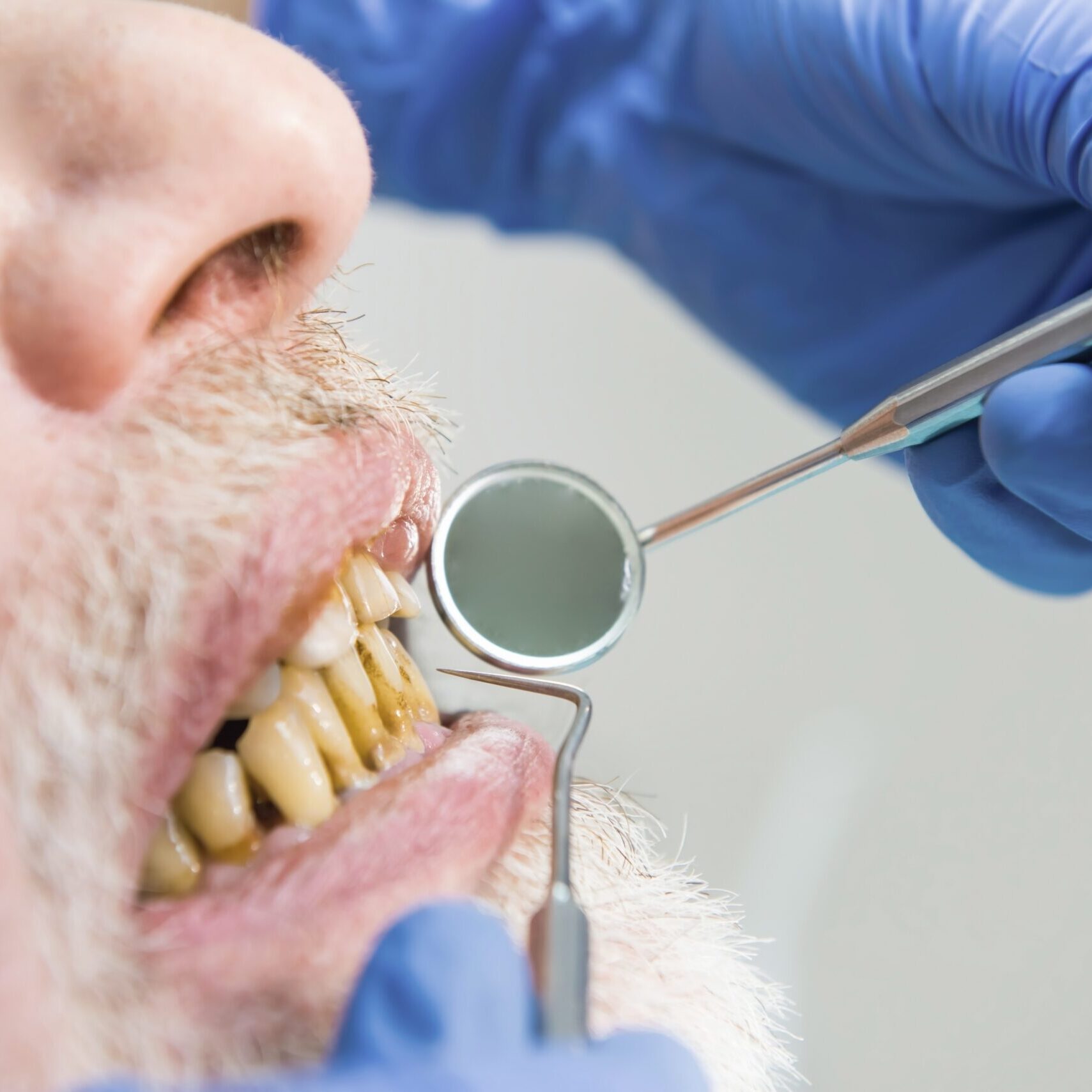 fluoride-treatments fluoride-treatments