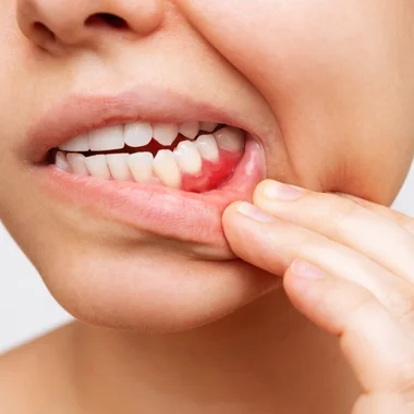 gum_disease gum_disease