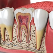 root-canal root-canal
